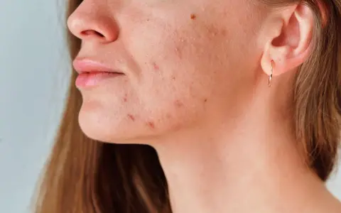 Primer plano de una mujer con marcas de acné en la mandíbula y el cuello.