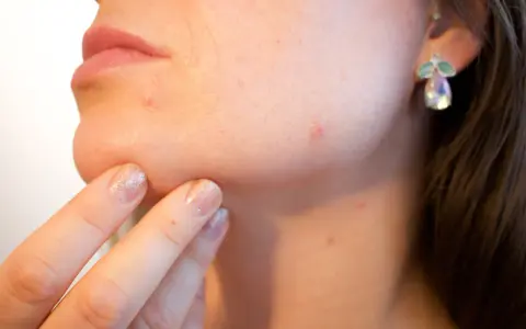 Dedo con uñas brillantes toca barbilla con granitos, buscando el efecto purga piel.