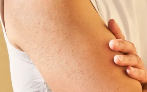 Brazo con pequeñas protuberancias rojas y blancas, indicativas de queratosis pilaris.