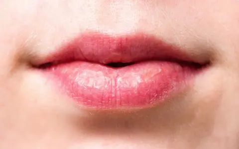 Labios rosados y agrietados, con signos de labios quemados por el sol.