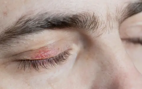 Párpado irritado con enrojecimiento y descamación, indicativo de dermatitis seborreica en las cejas y contorno del ojo.