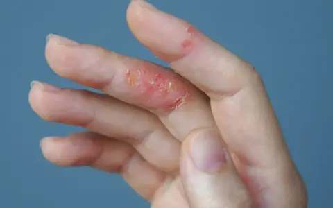 Mano con piel irritada y escamosa en los dedos, indicando picor en las manos.