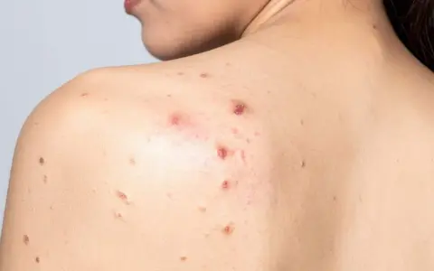 Granos por sudor en la espalda de una persona, algunos inflamados y rojos, otros más pequeños y secos.