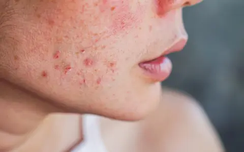 Primer plano de una mejilla con enrojecimiento y varias espinillas XXL infectadas, algunas con pus visible.