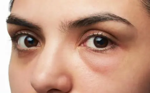 Ojos con ojeras marcadas y una leve hinchazón debajo, sugiriendo una cara hinchada tras una noche de poco descanso.