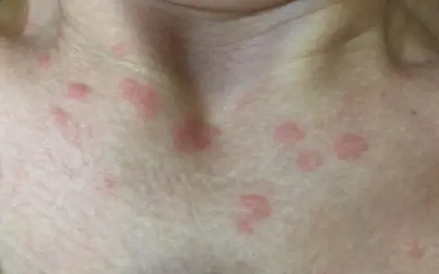 Manchas rojas en el cuello y pecho. ¿Cuándo preocuparse por manchas en la piel? Consulta a un médico si persisten o empeoran.