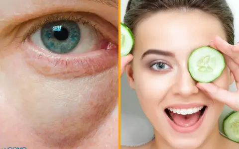 Ojo con bolsas y ojeras, comparado con una mujer sonriente usando rodajas de pepino, un remedio casero para las bolsas en los ojos.