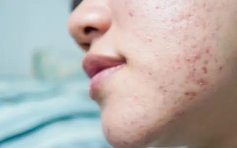 Primer plano de una mejilla con marcas de acné por estrés, mostrando rojeces e imperfecciones en la piel.