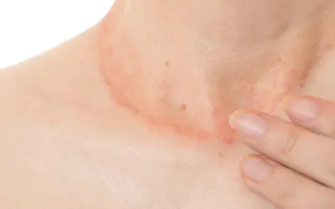 Piel enrojecida y con granos en el cuello, con una mano tocando suavemente la zona afectada.