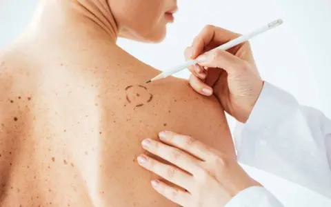 Médico marca con lápiz un lunar en la piel de un paciente. La piel tiene muchos lunares rojos y marrones.