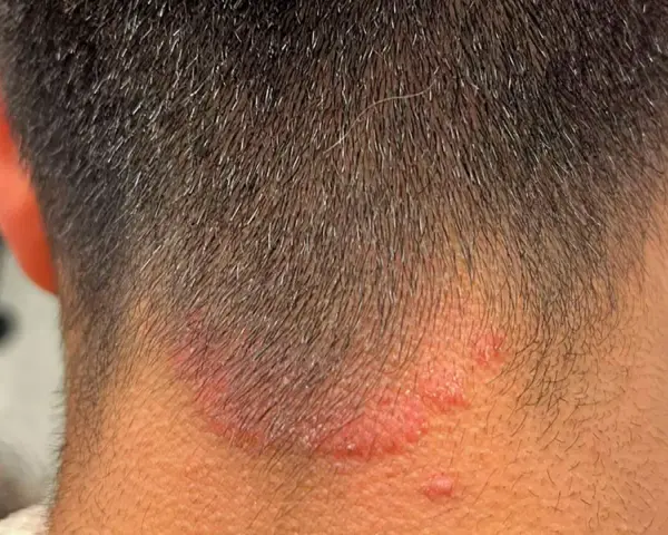 Irritación rojiza y escamosa en la nuca, sugiriendo la presencia de hongos en el cuello.
