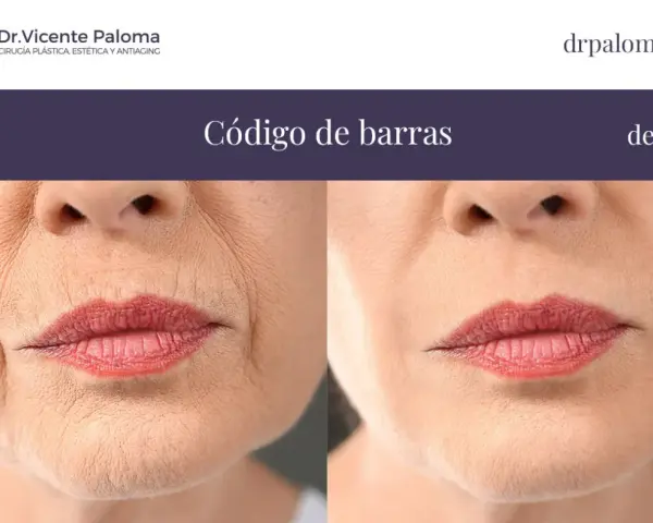 Antes y después de tratar el "código de barras" en los labios. Las arrugas verticales alrededor de la boca se suavizan.
