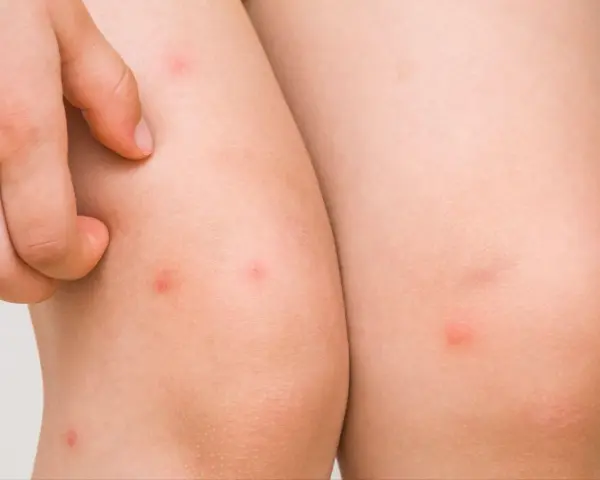Piel con pequeños bultos rojos, indicativos de foliculitis en las piernas. Un dedo rasca la zona irritada.