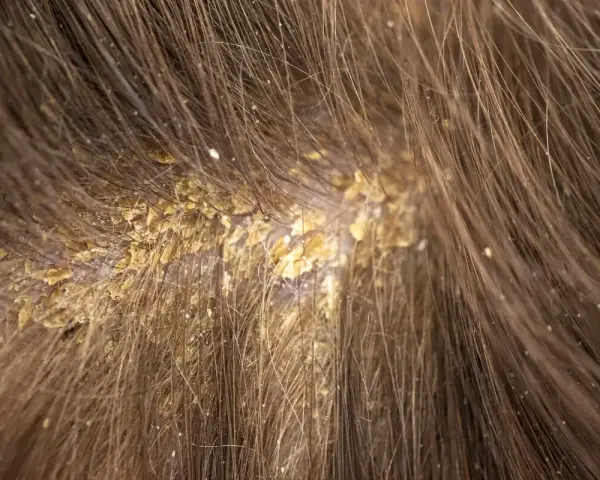Primer plano del cuero cabelludo con caspa, mostrando escamas amarillentas y una postilla blanca entre el cabello castaño.