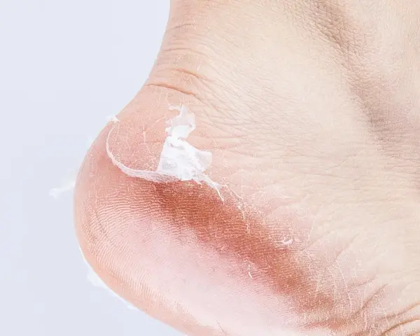 Primer plano de un talón con piel seca y descamada, mostrando por qué se pelan los pies.
