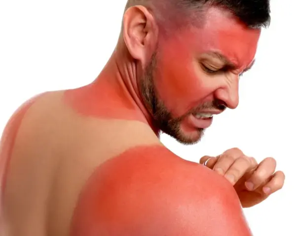 Hombre con quemaduras solares severas en cara y hombros. El vinagre para las quemaduras del sol podría aliviar su dolor.