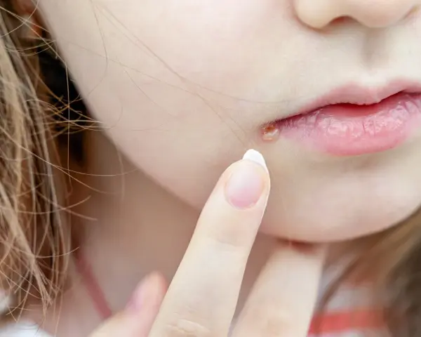 Dedo aplicando crema en granos en los labios.