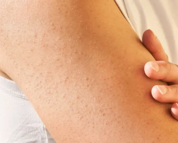 Brazo con pequeñas protuberancias rojas y blancas, indicativas de queratosis pilaris.