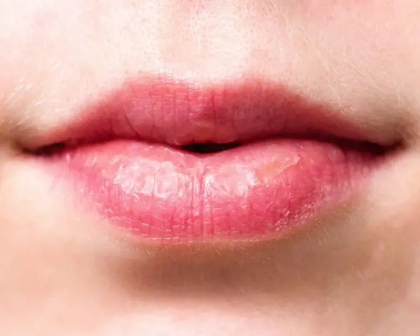 Labios rosados y agrietados, con signos de labios quemados por el sol.