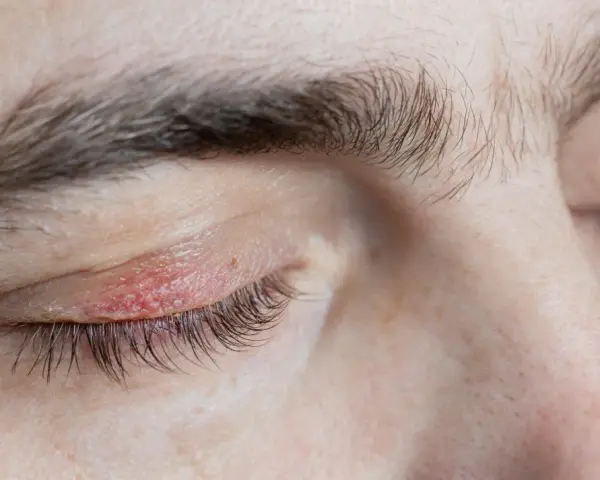 Párpado irritado con enrojecimiento y descamación, indicativo de dermatitis seborreica en las cejas y contorno del ojo.
