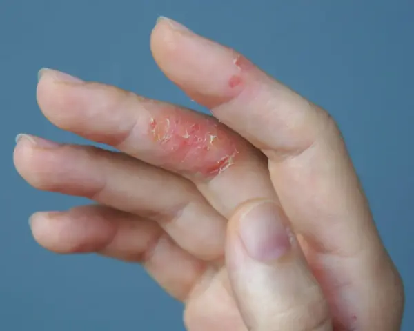 Mano con piel irritada y escamosa en los dedos, indicando picor en las manos.