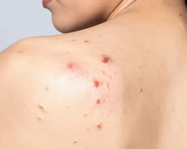 Granos por sudor en la espalda de una persona, algunos inflamados y rojos, otros más pequeños y secos.