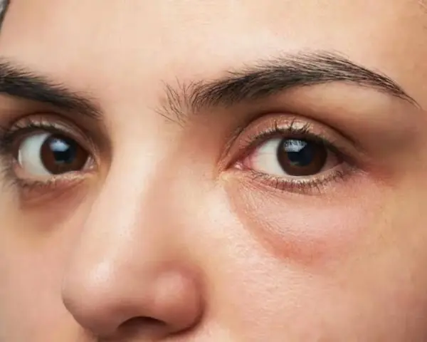 Ojos con ojeras marcadas y una leve hinchazón debajo, sugiriendo una cara hinchada tras una noche de poco descanso.