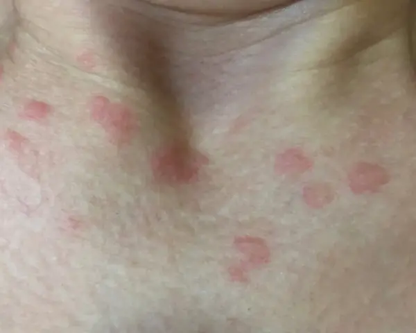 Manchas rojas en el cuello y pecho. ¿Cuándo preocuparse por manchas en la piel? Consulta a un médico si persisten o empeoran.