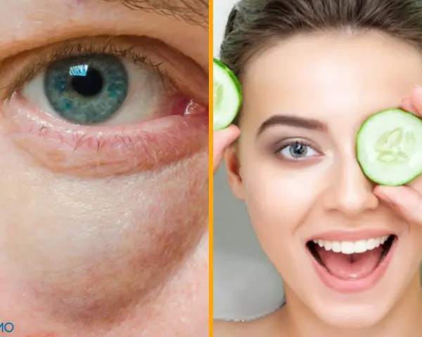 Ojo con bolsas y ojeras, comparado con una mujer sonriente usando rodajas de pepino, un remedio casero para las bolsas en los ojos.
