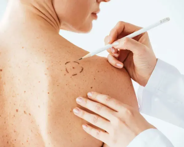 Médico marca con lápiz un lunar en la piel de un paciente. La piel tiene muchos lunares rojos y marrones.