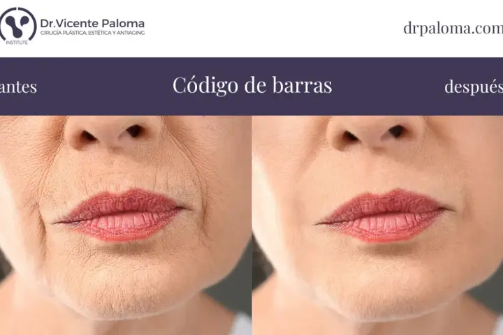 Antes y después de tratar el "código de barras" en los labios. Las arrugas verticales alrededor de la boca se suavizan.