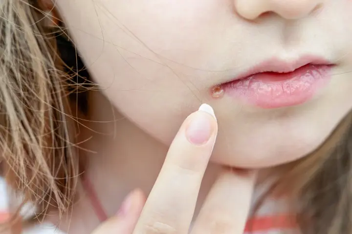 Dedo aplicando crema en granos en los labios.