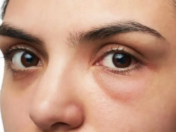 Ojos con ojeras marcadas y una leve hinchazón debajo, sugiriendo una cara hinchada tras una noche de poco descanso.