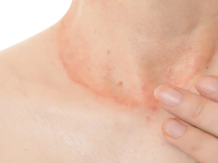 Piel enrojecida y con granos en el cuello, con una mano tocando suavemente la zona afectada.