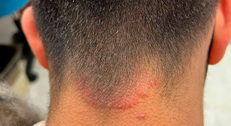 Irritación rojiza y escamosa en la nuca, sugiriendo la presencia de hongos en el cuello.