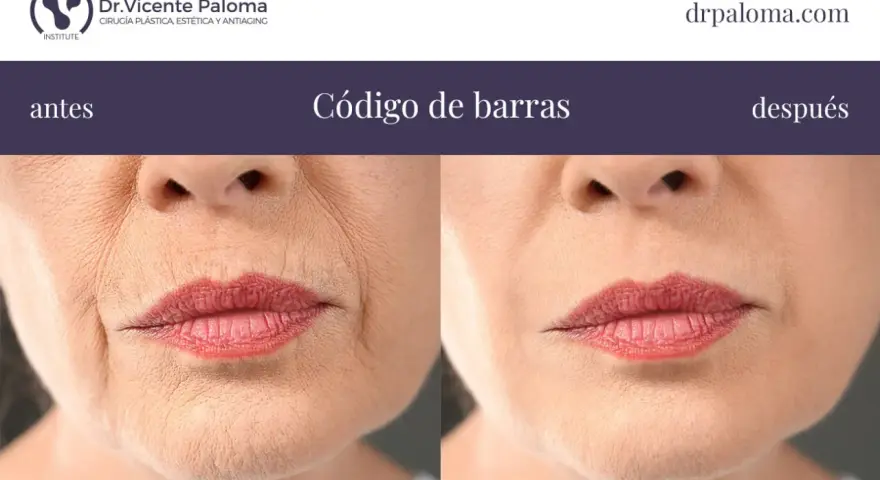 Antes y después de tratar el "código de barras" en los labios. Las arrugas verticales alrededor de la boca se suavizan.
