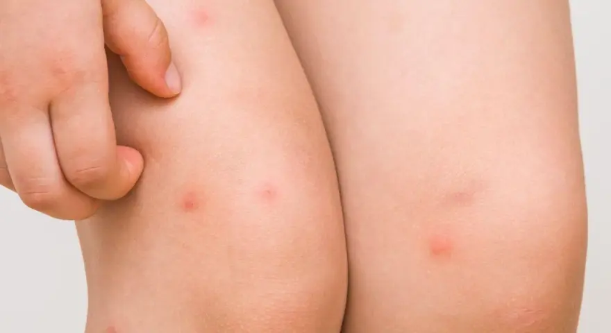 Piel con pequeños bultos rojos, indicativos de foliculitis en las piernas. Un dedo rasca la zona irritada.