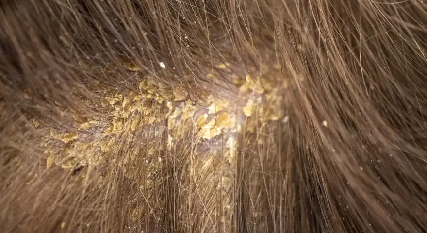 Primer plano del cuero cabelludo con caspa, mostrando escamas amarillentas y una postilla blanca entre el cabello castaño.
