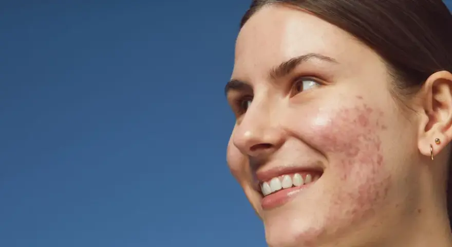 Mujer sonríe con granos entrecejo y mejillas. Piel con acné, fondo azul cielo.