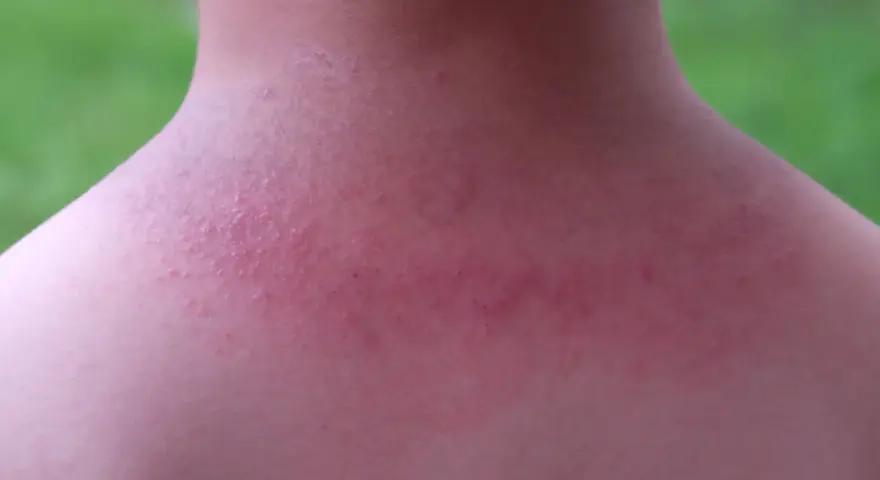 Piel enrojecida con pequeños bultos rojos en el cuello y hombros, indicativo de sarpullido por calor en adultos.