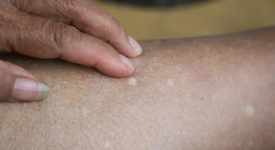 Una mano con un anillo toca la piel, revelando varias manchitas blancas en la piel, algunas más notorias que otras.