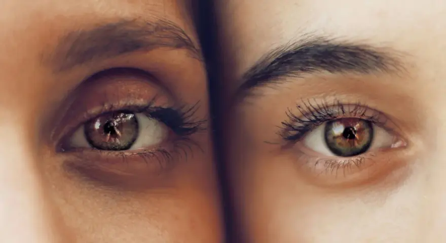 Ojos hundidos antes y después. Comparación de dos ojos, uno con ojeras marcadas y otro con piel más lisa y luminosa.