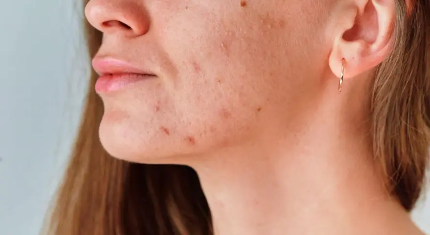 Primer plano de una mujer con marcas de acné en la mandíbula y el cuello.