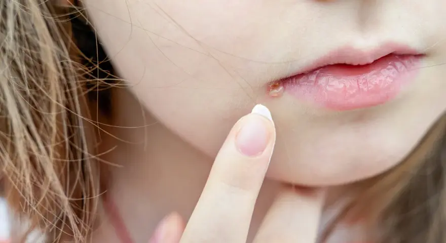 Dedo aplicando crema en granos en los labios.