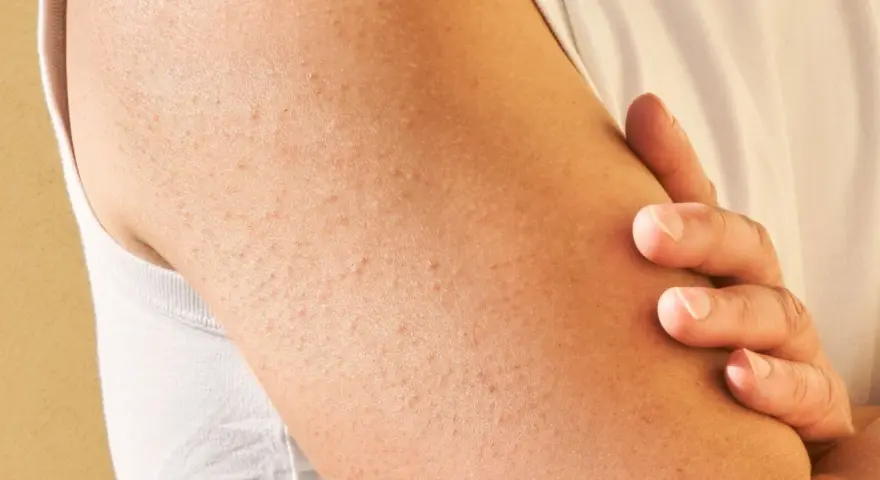 Brazo con pequeñas protuberancias rojas y blancas, indicativas de queratosis pilaris.