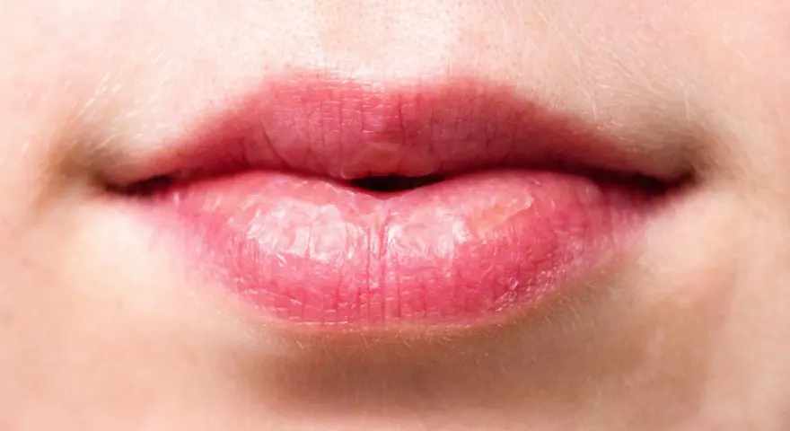 Labios rosados y agrietados, con signos de labios quemados por el sol.
