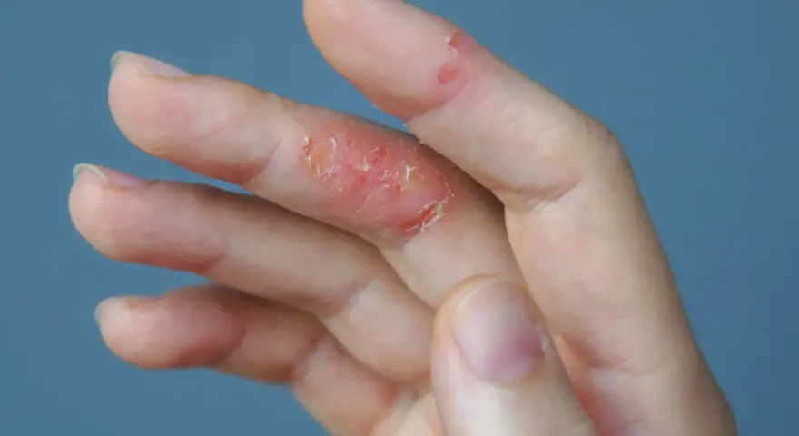 Mano con piel irritada y escamosa en los dedos, indicando picor en las manos.