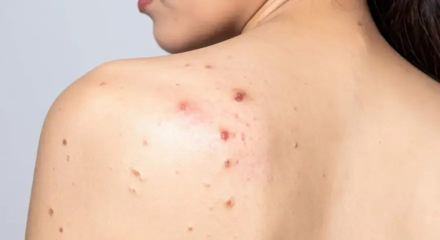 Granos por sudor en la espalda de una persona, algunos inflamados y rojos, otros más pequeños y secos.