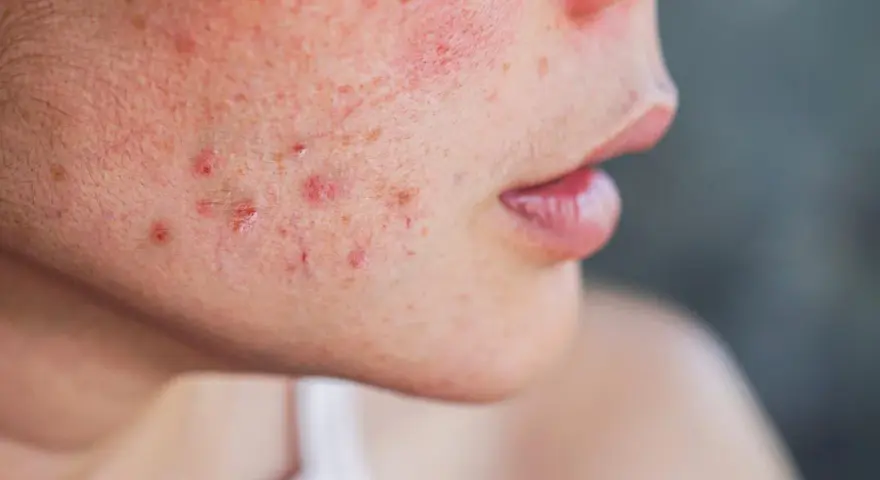 Primer plano de una mejilla con enrojecimiento y varias espinillas XXL infectadas, algunas con pus visible.