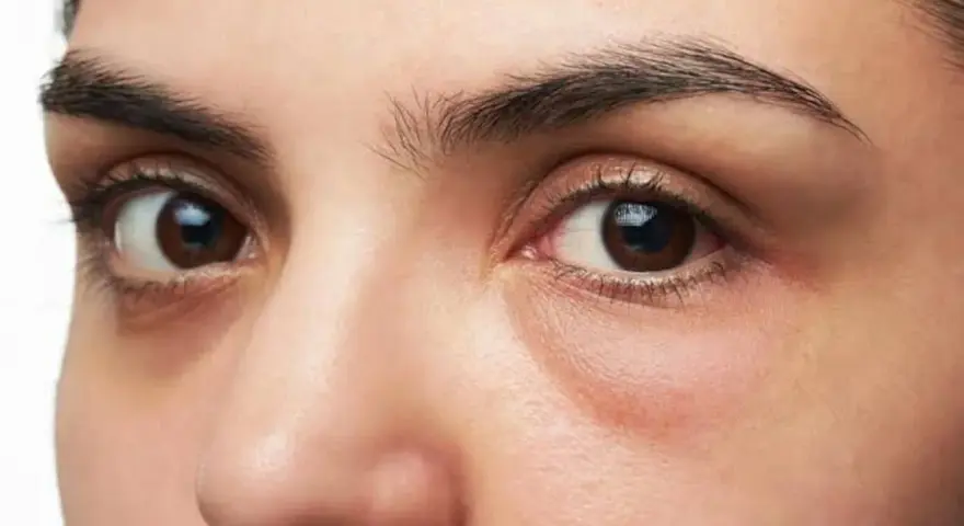 Ojos con ojeras marcadas y una leve hinchazón debajo, sugiriendo una cara hinchada tras una noche de poco descanso.